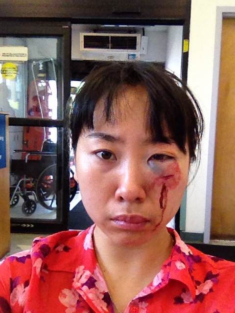 黄女士眼部严重受伤.(当事人本人提供)